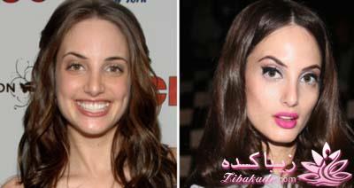 جراحی بینی - جراحی زیبایی